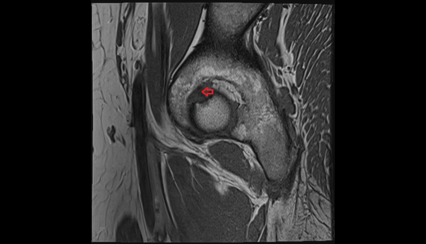 Ligamentum Teres (ligament of the head of femur)  MRI  sag  anatomy image-img-00000-00000