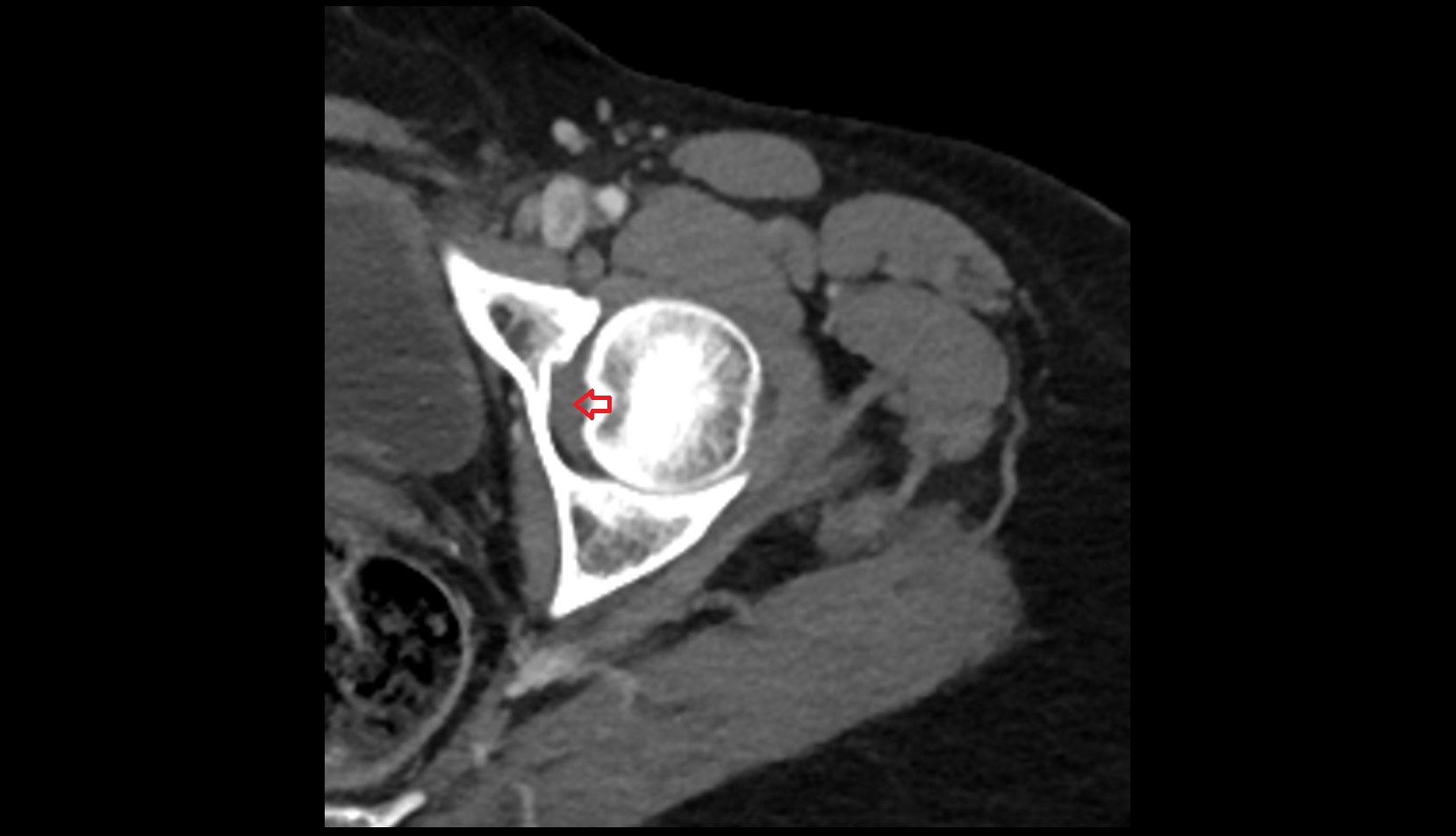 Ligamentum Teres (ligament of the head of femur) ct axial image