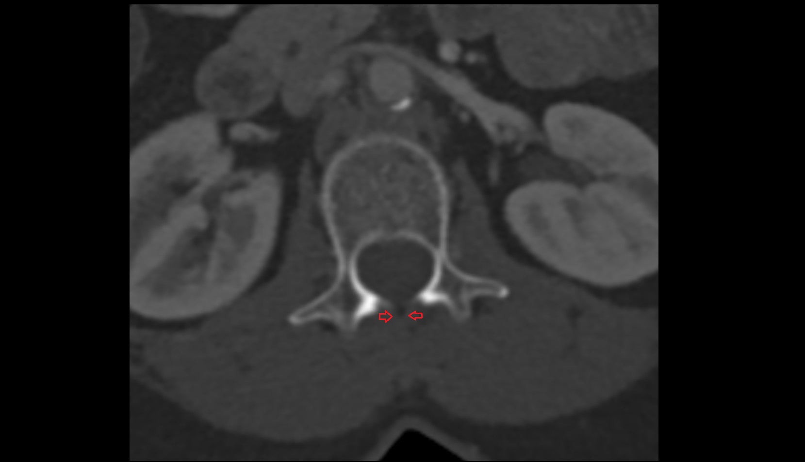 Ligamentum flavum ct axial image