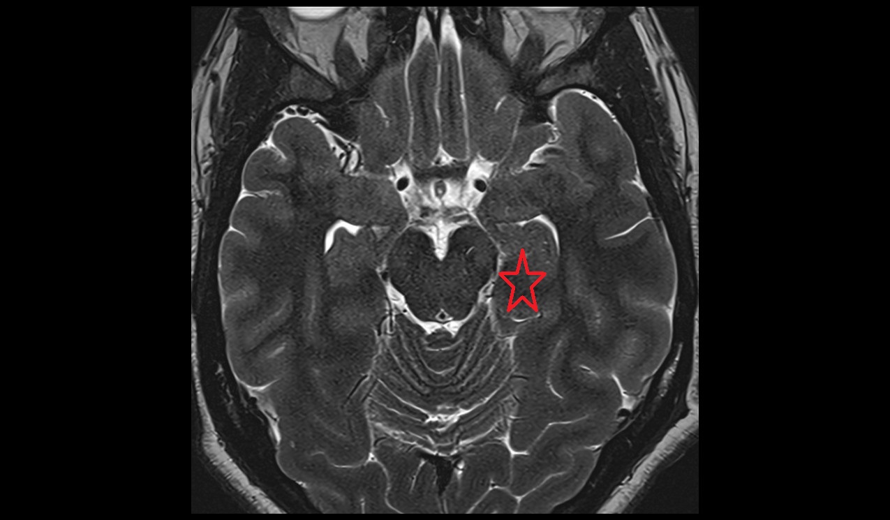 Limbic lobe mri image