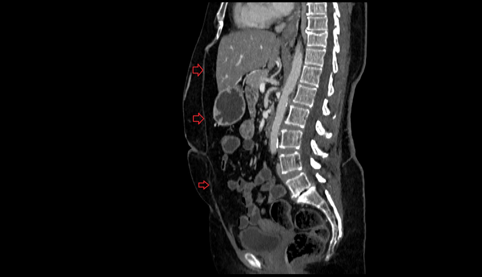 Linea alba CT SAG image