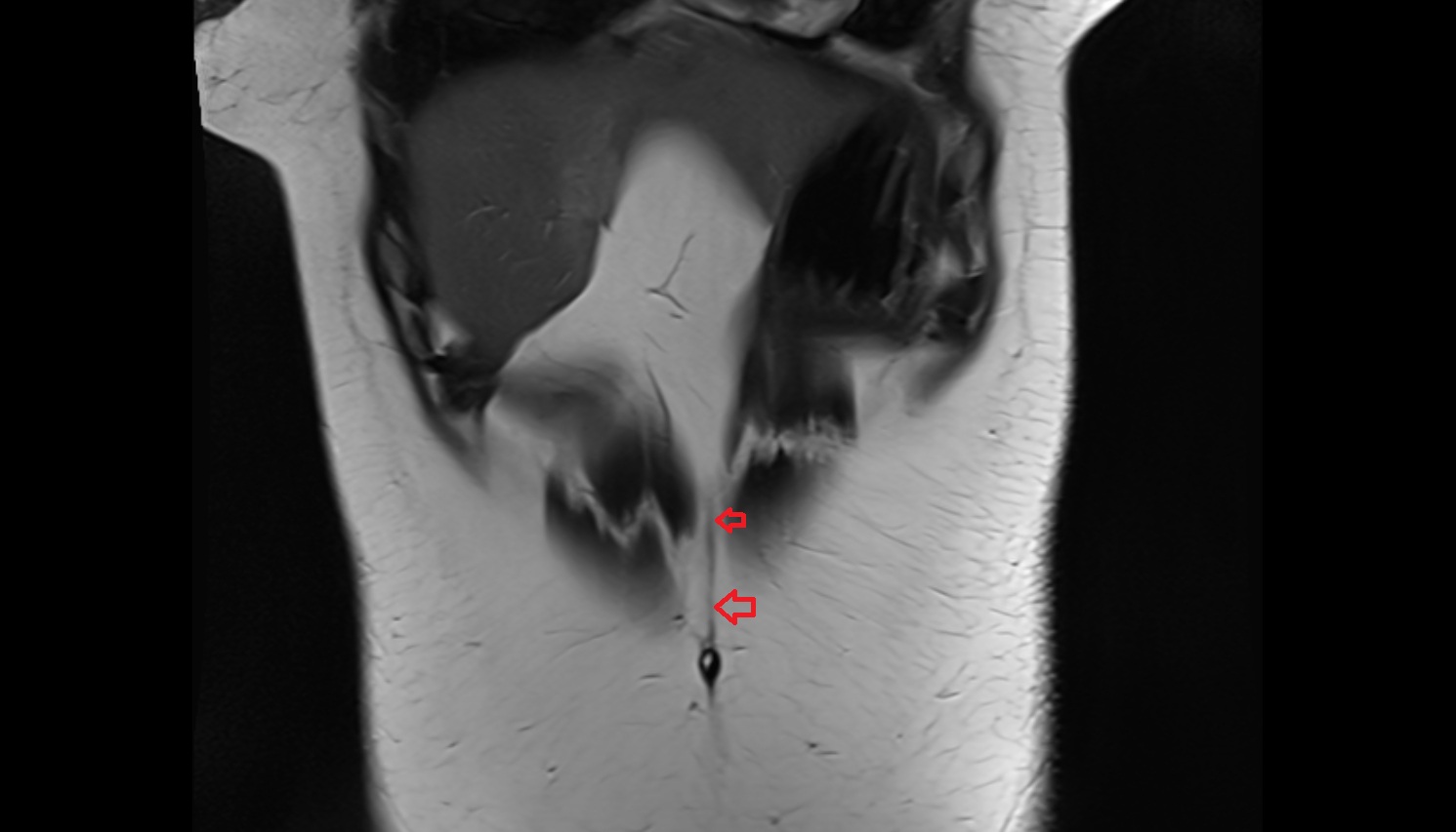 Linea alba  MRI CORONAL  anatomy  image-img-00000-00000