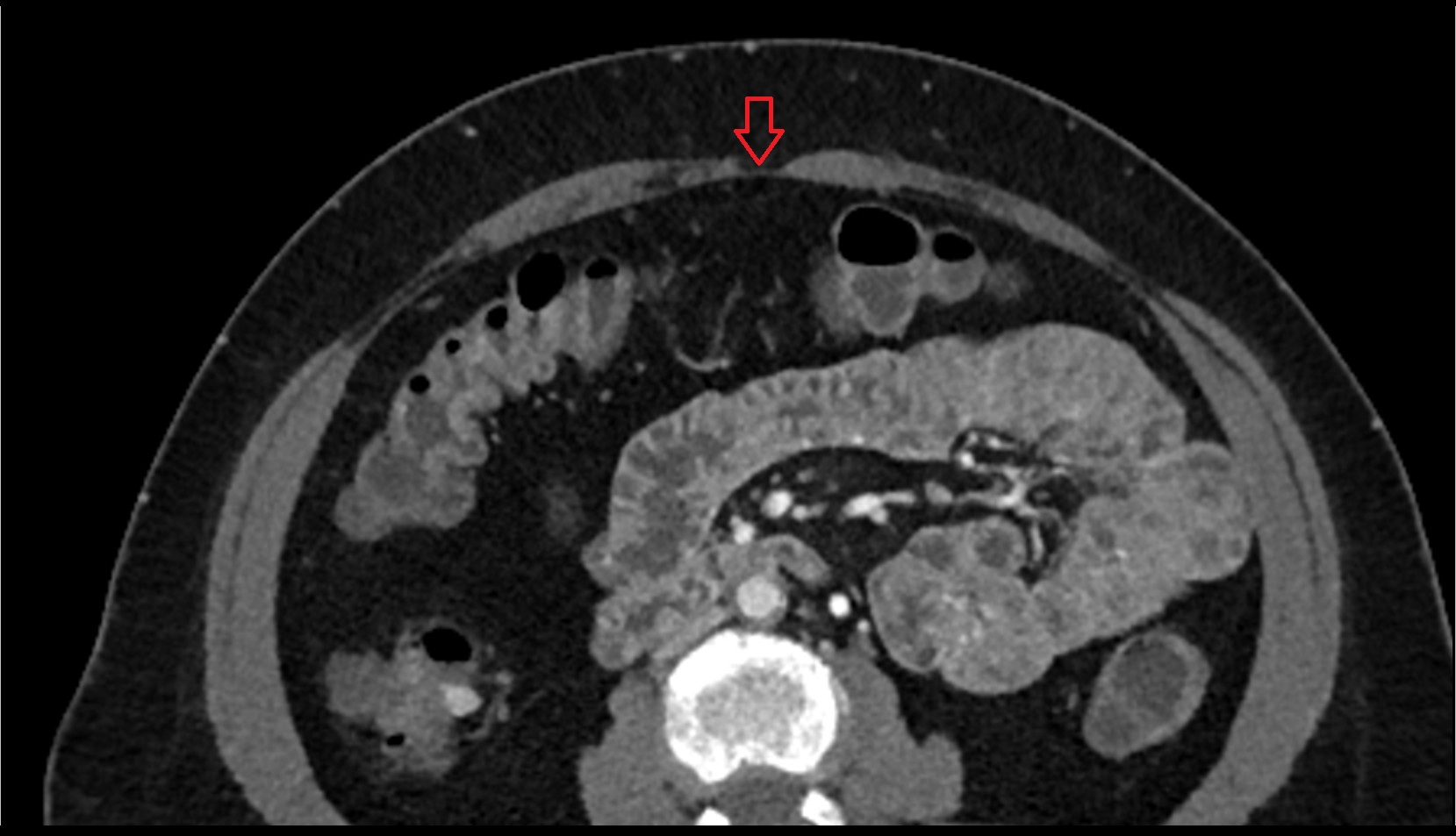 Linea alba  axial image 1