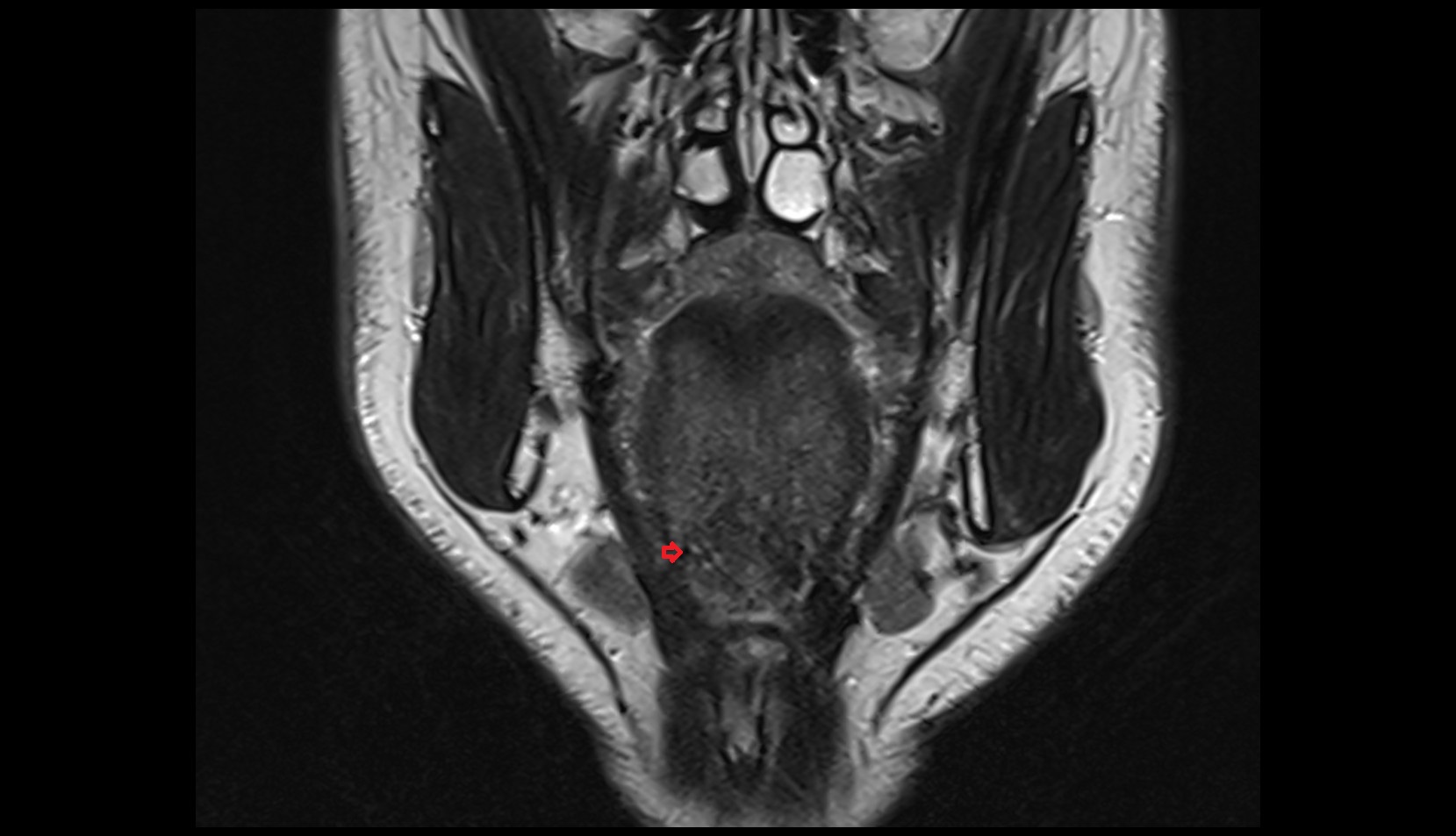 Lingual artery coronal t2 image