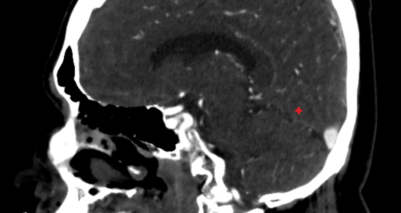 Lingual gyrus  CT sag anatomy image -img-00001-00001