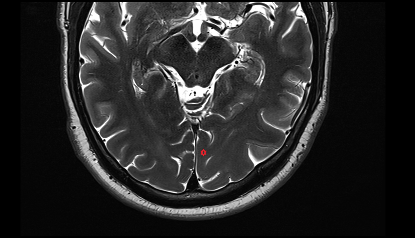 Lingual gyrus mri 3t axial image