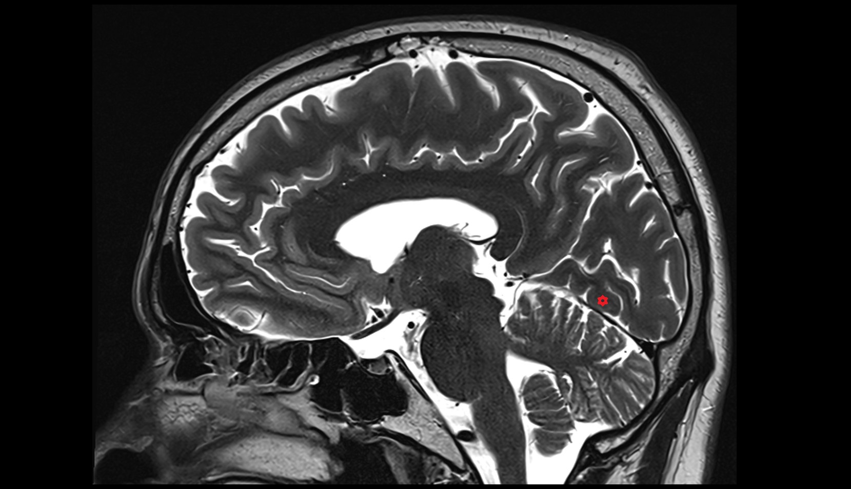 Lingual gyrus mri 3t sagittal image