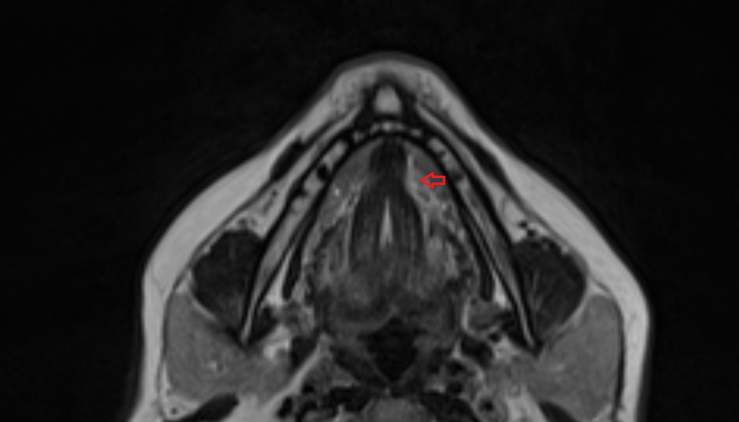Lingual lymph nodes mri axial  image -img-00000-00000