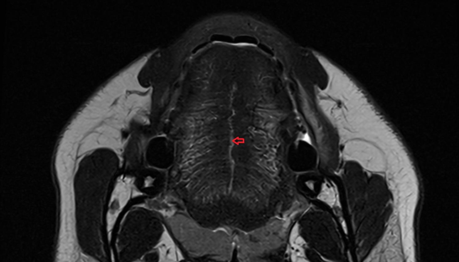 Lingual septum mri image -img-00000-00000