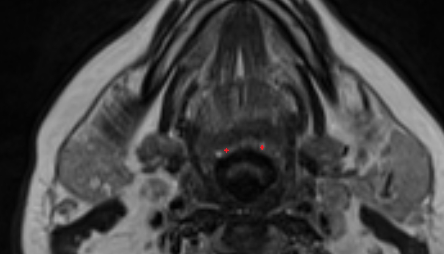 Lingual tonsil mri image -img-00000-00000