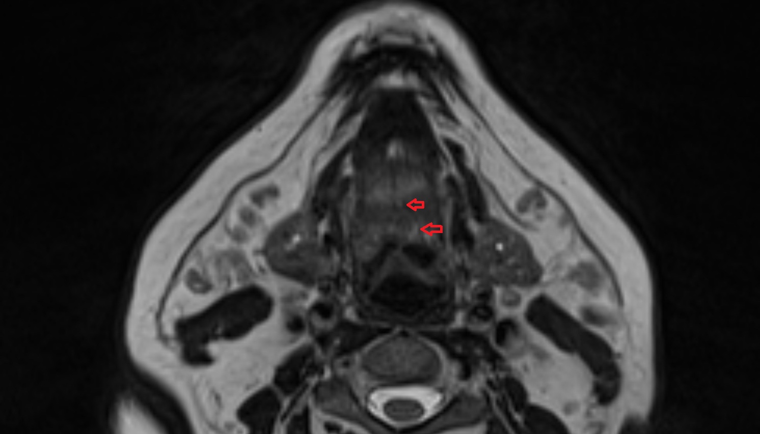 Lingual vein mri axial  image -img-00000-00000