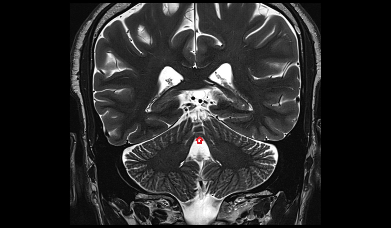 Lingula of cerebellum [I] MRI 3T coronal image