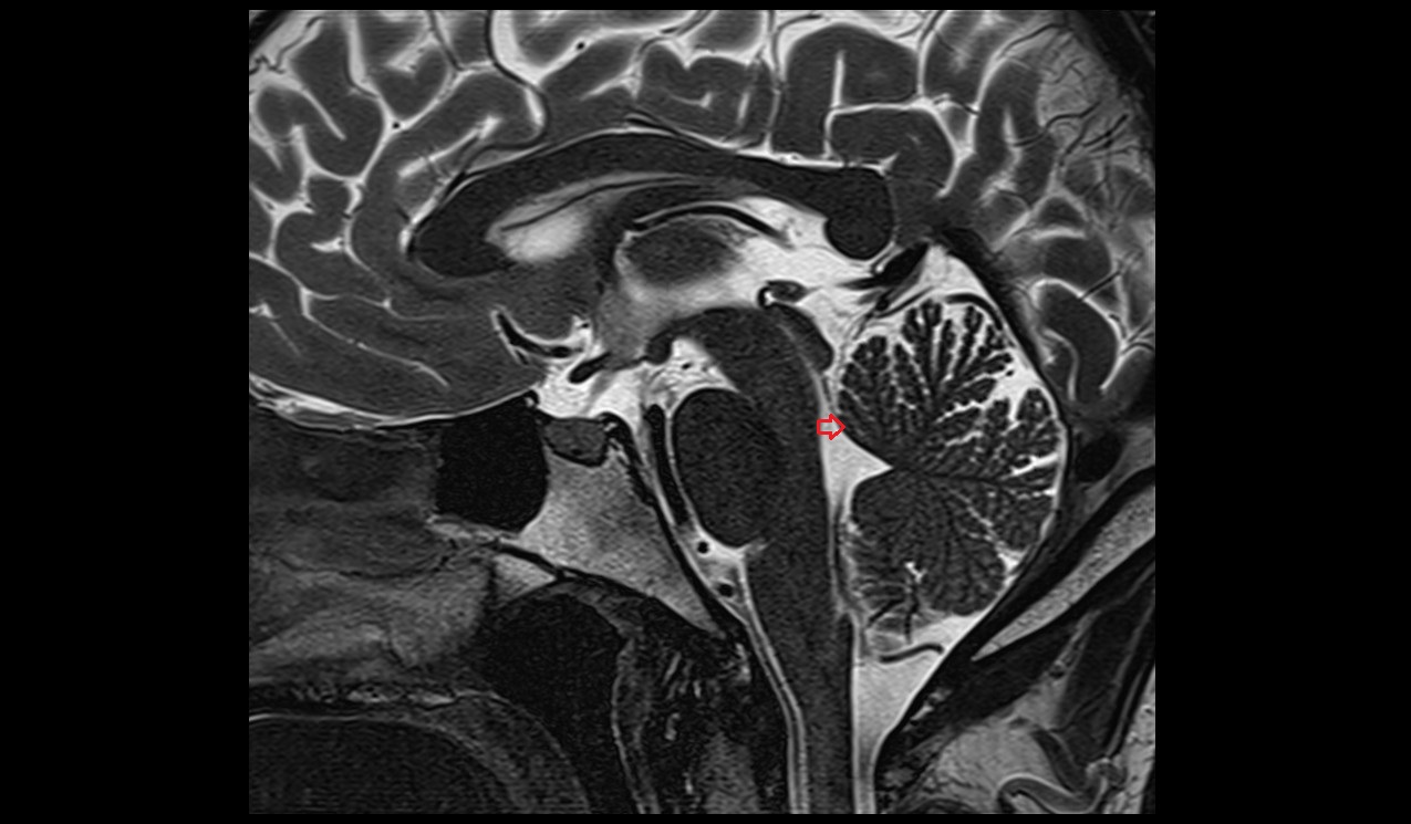 Lingula of cerebellum [I] MRI 3T sagittal image