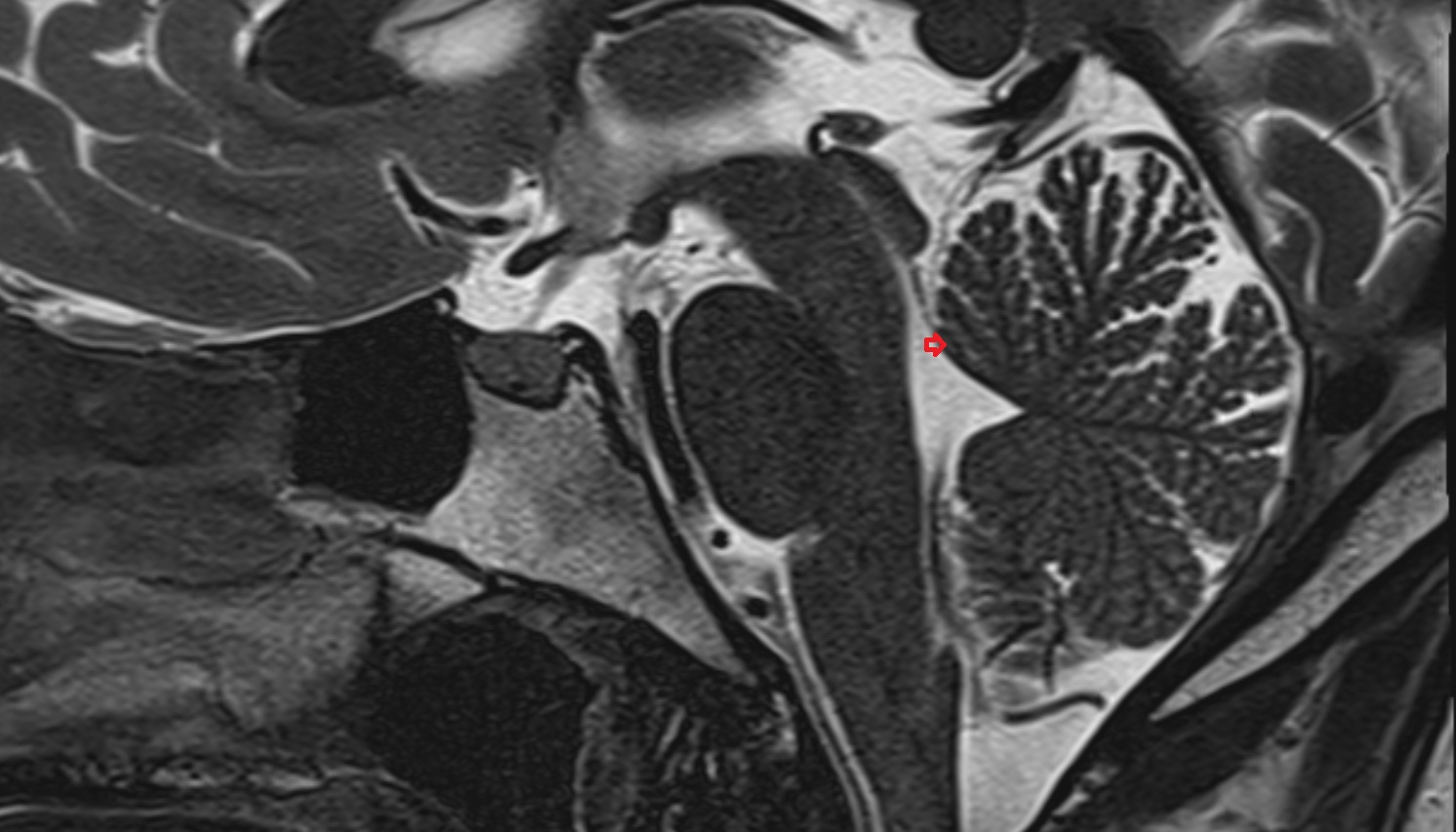 Lingula of cerebellum (I)  mri sag  image -img-00000-00000