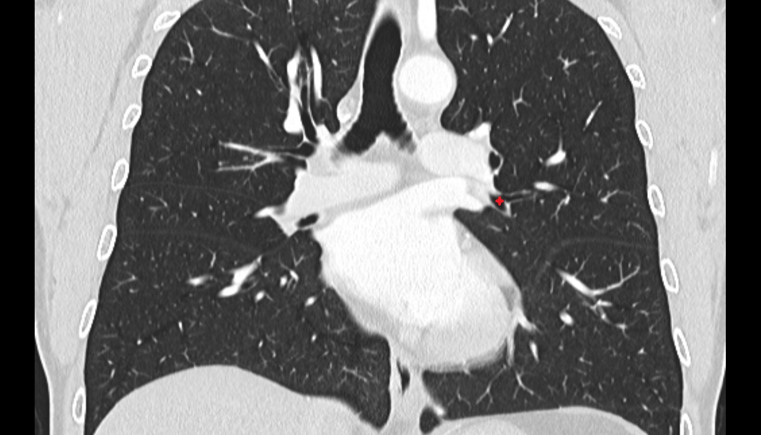 Lingular bronchus of left lung  anatomy  CT coronal  image -img-00000-00000