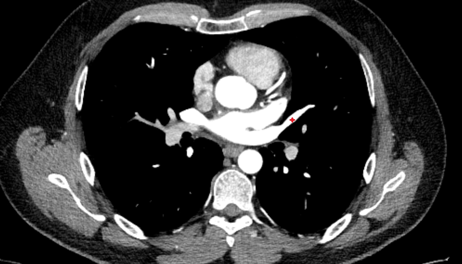 Lingular vein of left lung  anatomy CT axial  image -img-00000-00000
