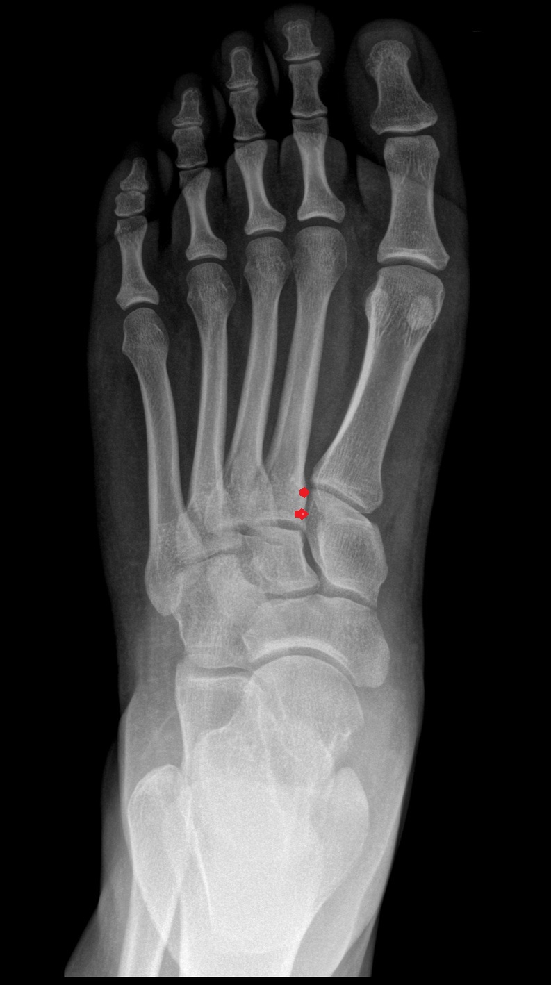 Lisfranc complex