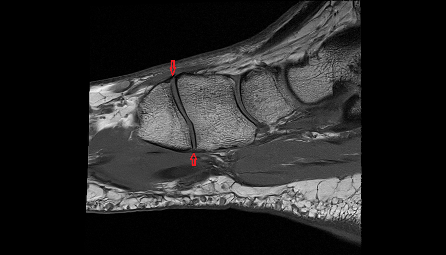 Lisfranc complex  mri  anatomy labelled image-img-00000-00000_00001