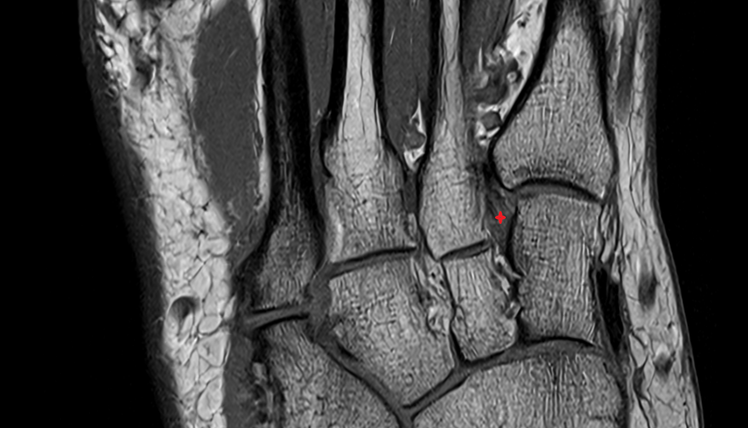 Lisfranc ligament  AXIAL cross sectional anatomy 3T MRI AI enhanced radiology image-img-00000-00000