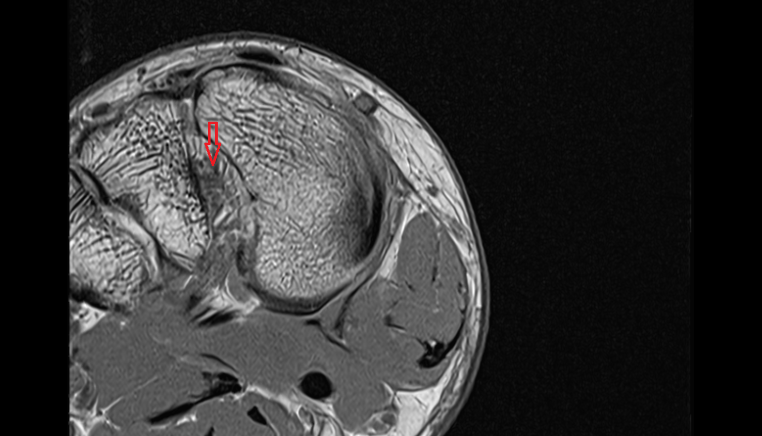 Lisfranc ligament  CORONAL cross sectional anatomy 3T MRI AI enhanced radiology image-img-00000-00000