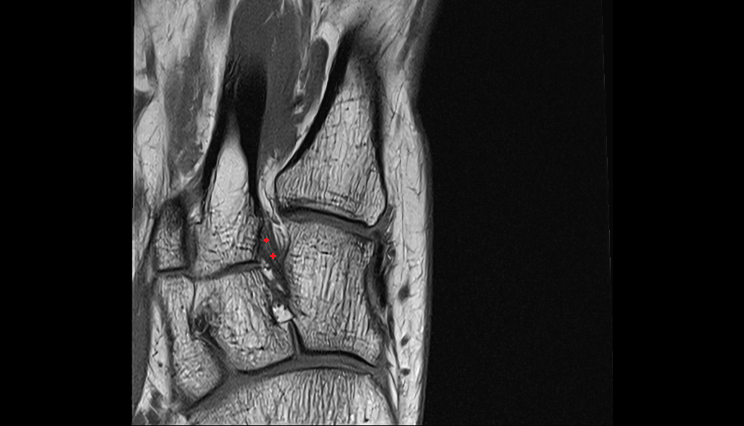 Lisfranc ligament coronal cross sectional anatomy 3T MRI AI enhanced radiology image-img-00000-00000