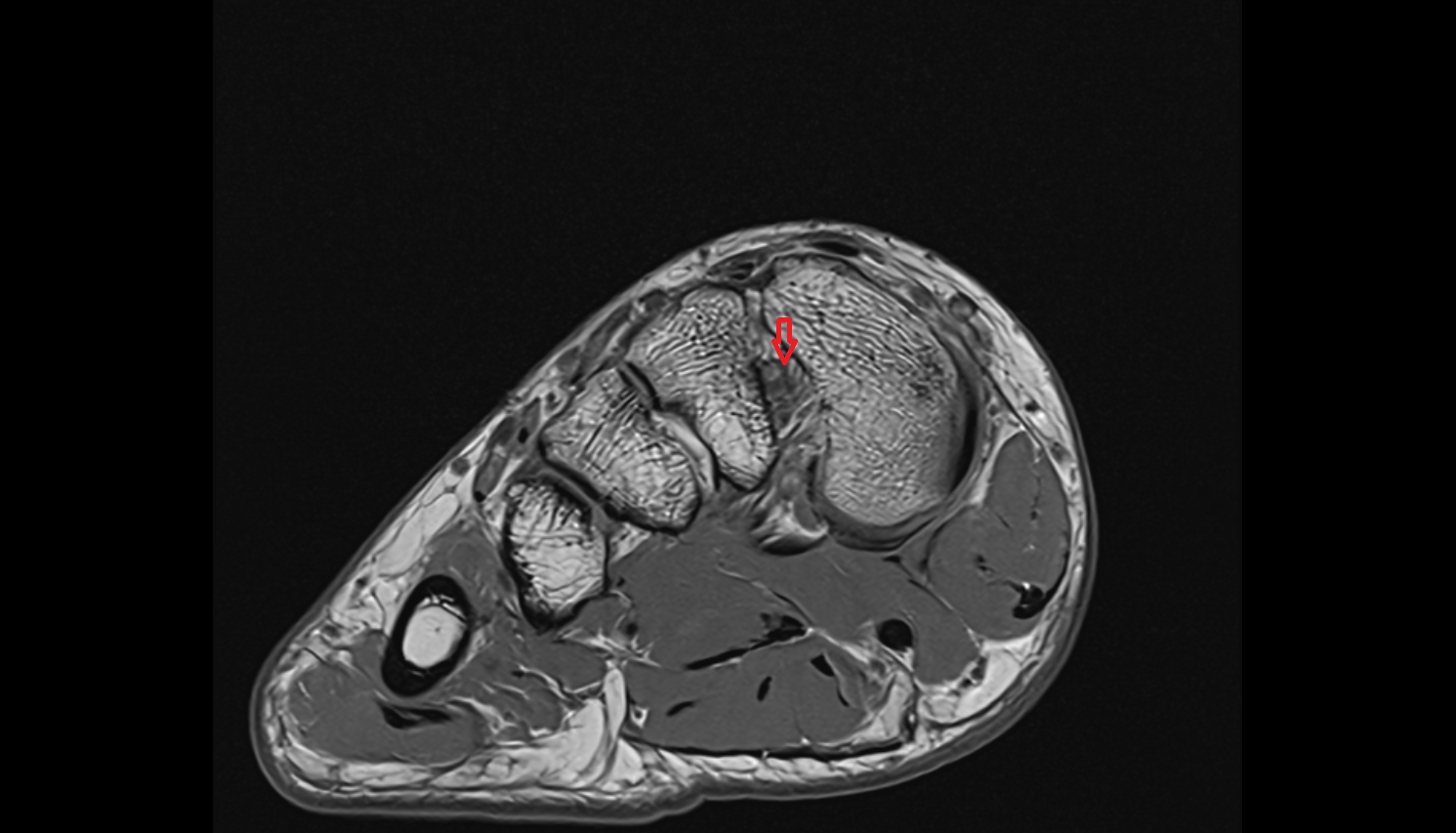 Lisfranc ligament coronal cross sectional anatomy 3T MRI AI enhanced radiology image-img-00000-00000_00001