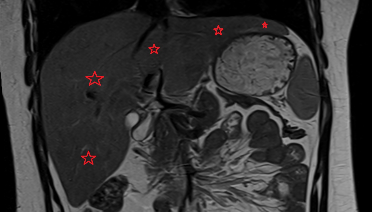 Liver  MRI  CORONAL  image -img-00000-00000