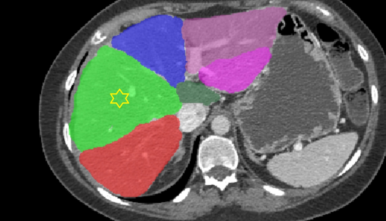 Liver Right anterosuperior segment — Segment VIII   CT  axial  anatomy  image