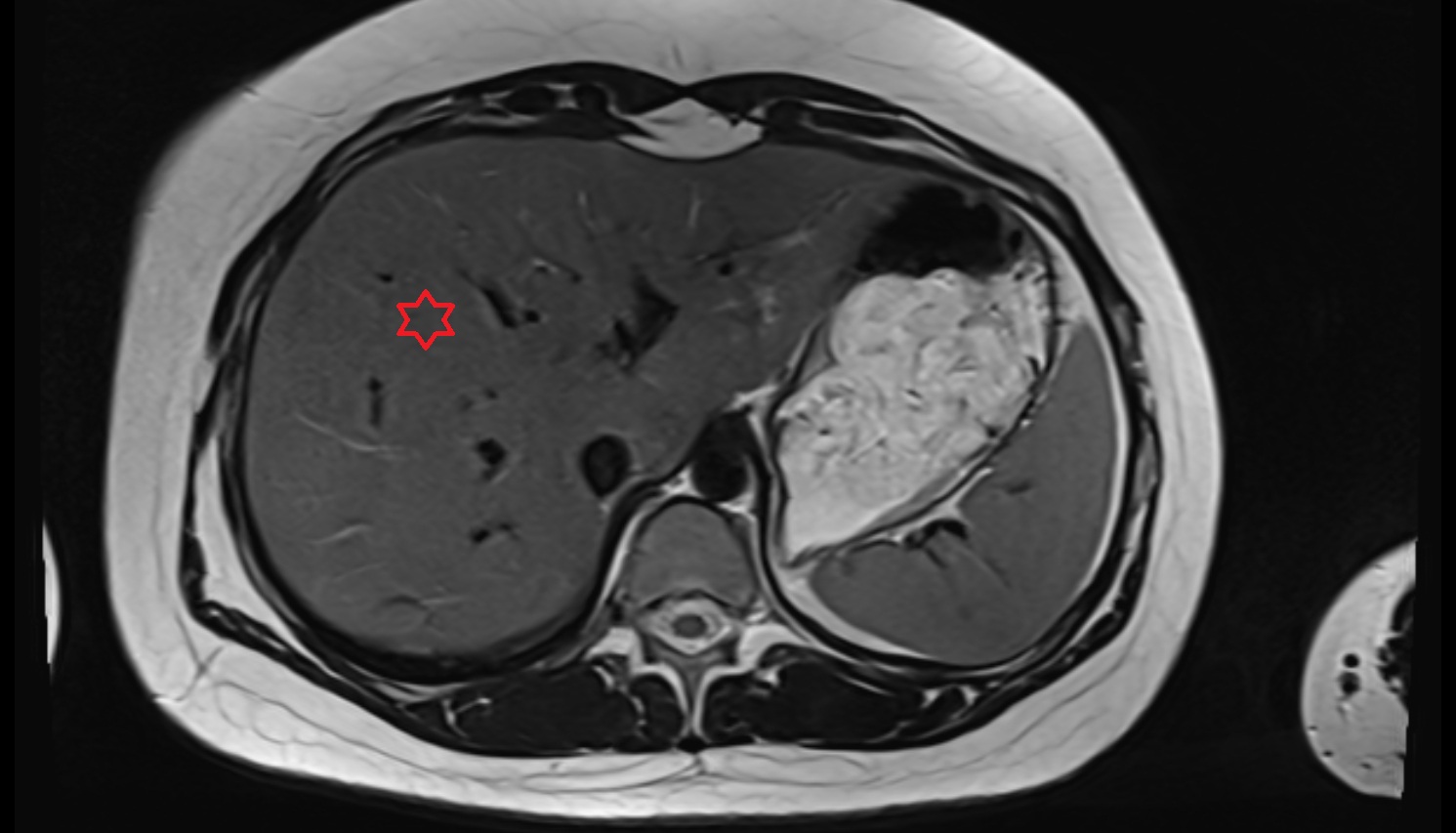 Liver Right anterosuperior segment — Segment VIII  MRI  axial  anatomy  image