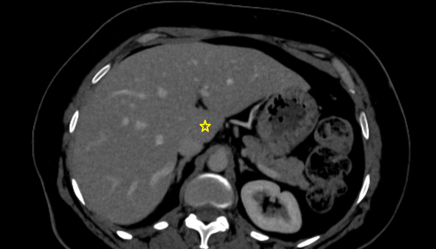 Liver Segment I – Caudate lobe  CT  axial  anatomy  image