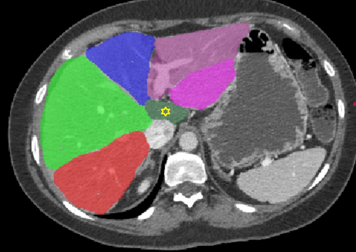 Liver Segment I – Caudate lobe  CT  axial  anatomy  image
