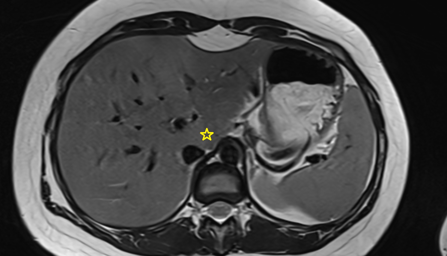 Liver Segment I – Caudate lobe MRI  axial  anatomy  image