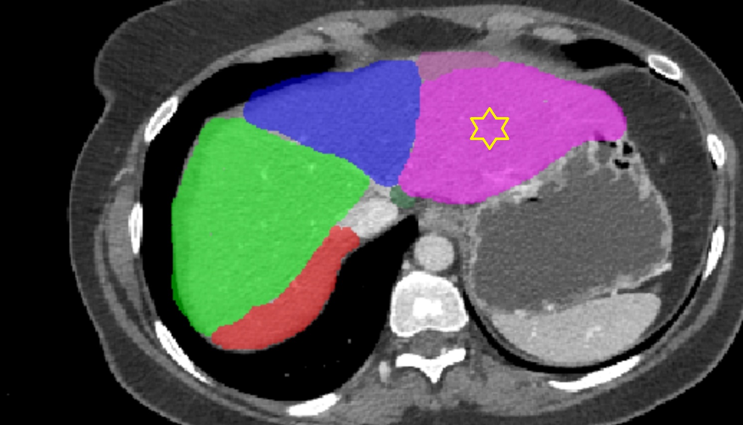 Liver Segment II – Left lateral superior segment   CT  axial  anatomy  image