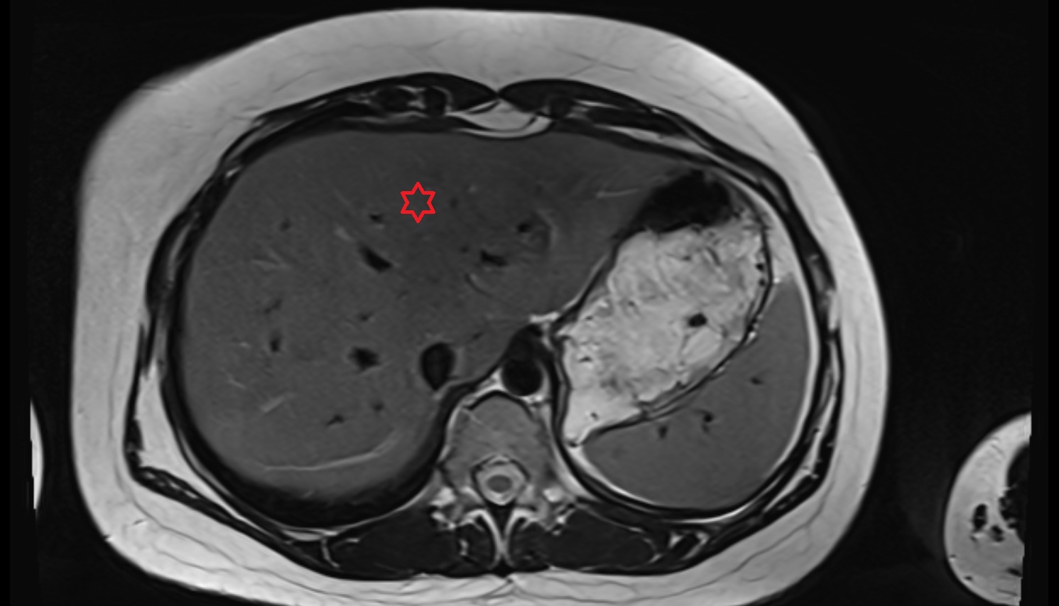 Liver Segment IVa – Left medial superior segment CT  axial  anatomy  image-img-00000-00000