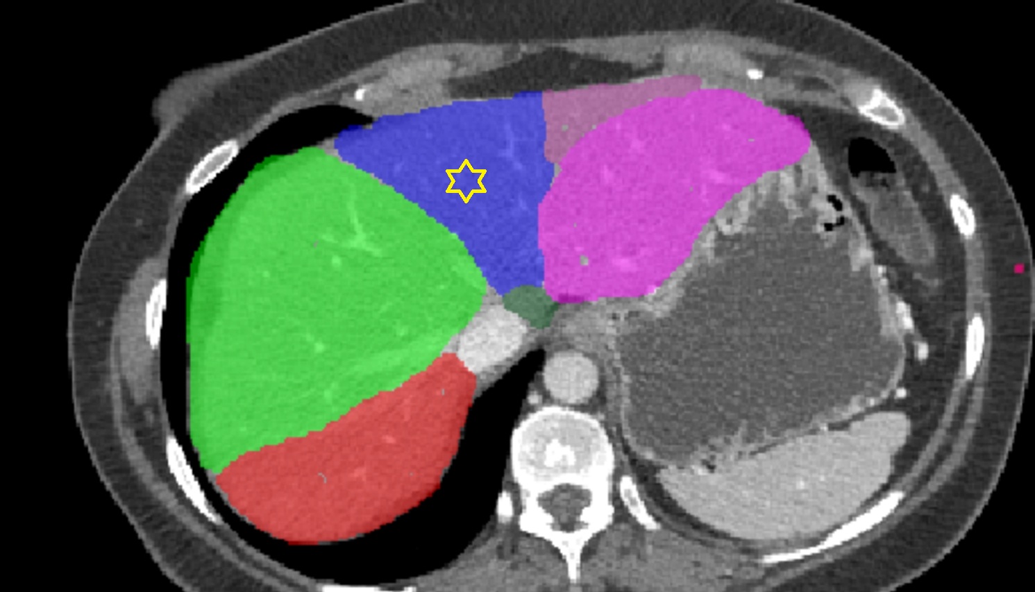 Liver Segment IVa – Left medial superior segment CT  axial  anatomy  image