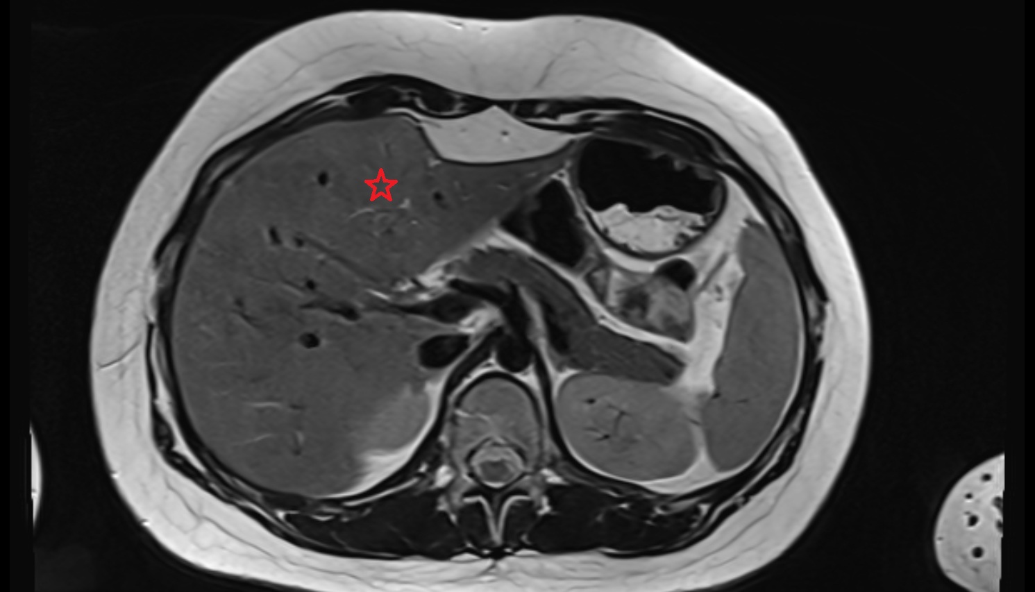 Liver Segment IVb – Left medial inferior segment  MRI  axial  anatomy  image-img-00000-00000