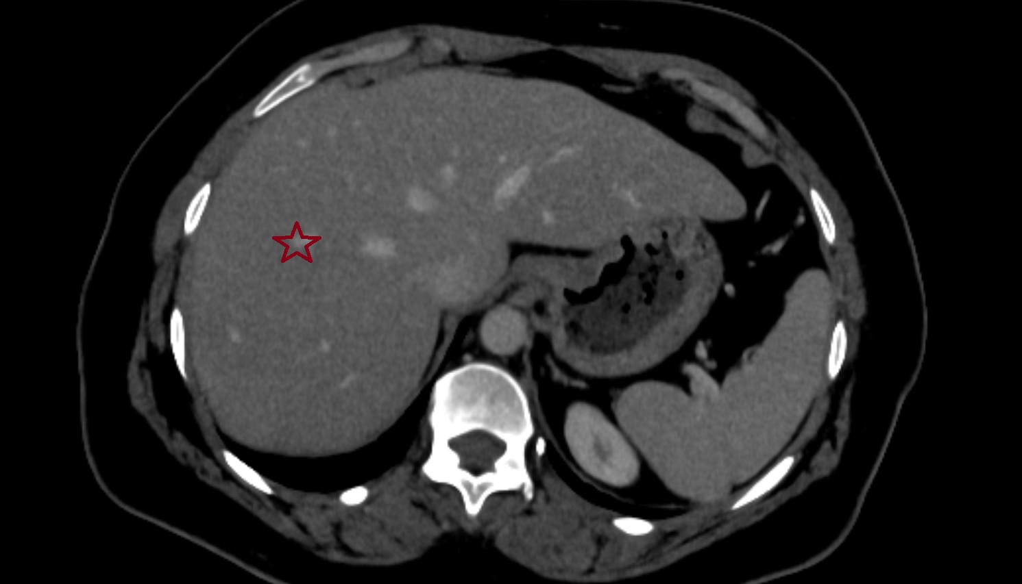 Liver Segment VIII – Right anterosuperior segment  CT  axial  anatomy  image