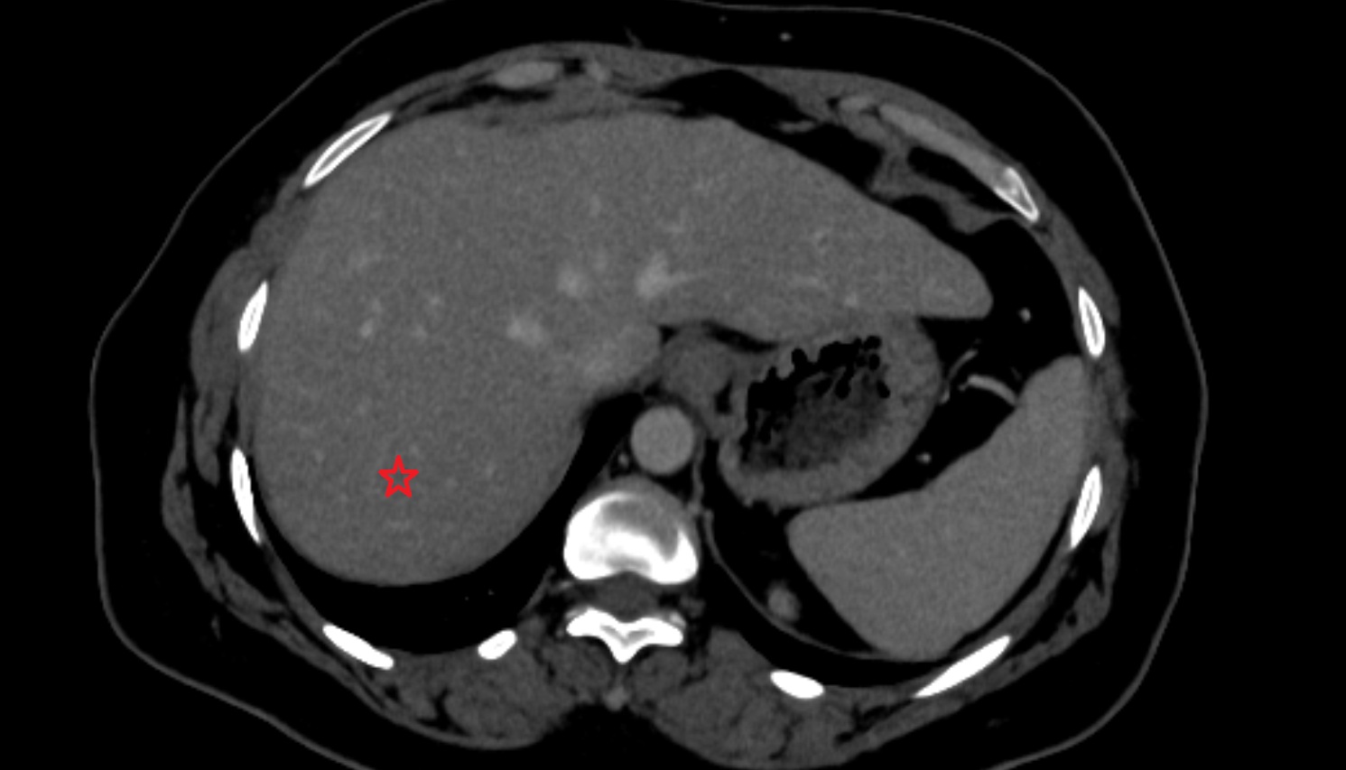 Liver Segment VII – Right posterosuperior segment  CT  axial  anatomy  image