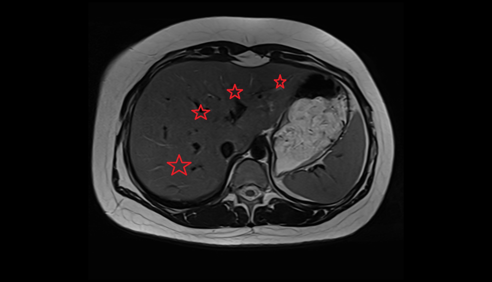 Liver mr anatomyi image