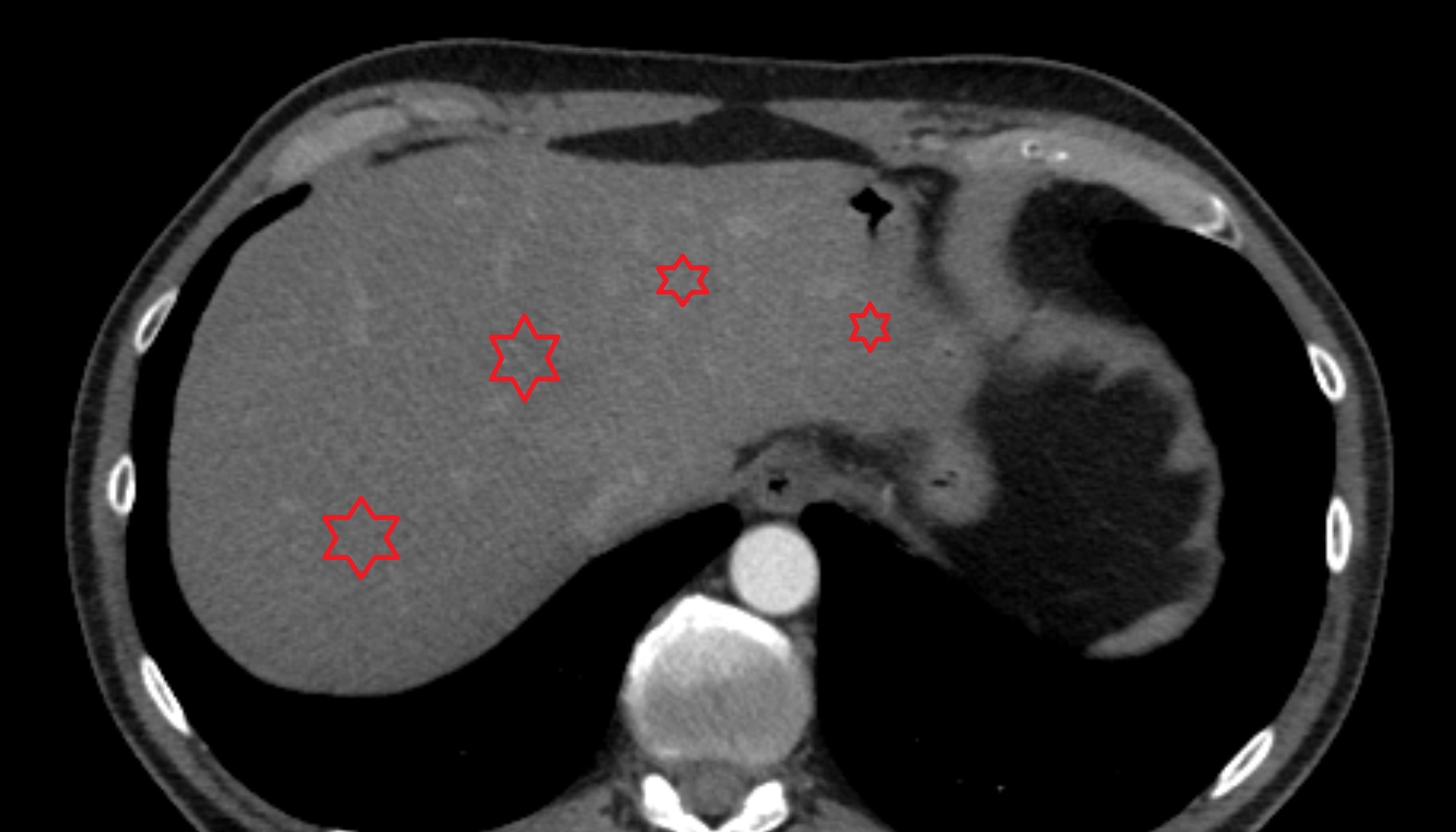 Lliver CT axial  image -img-00000-00000