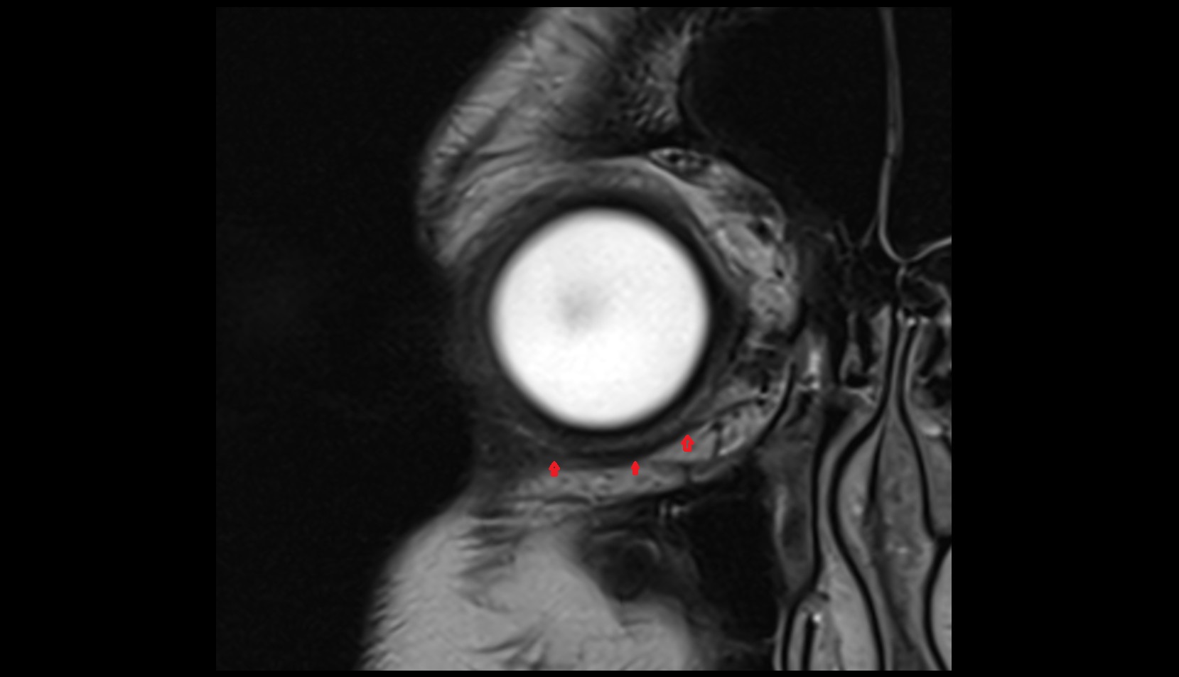 Lockwood’s ligament mri image