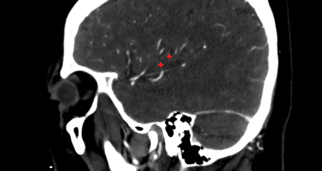Long gyri of insula  CT sag anatomy image -img-00001-00001
