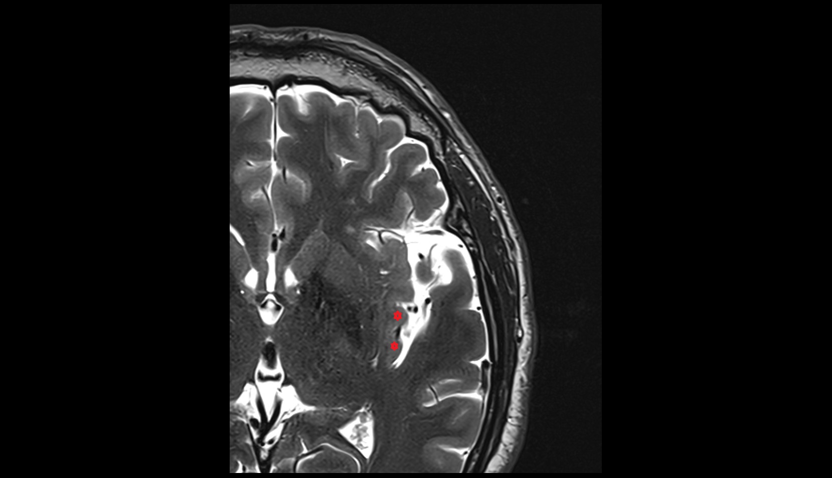Long gyri of insula mri 3t axial image