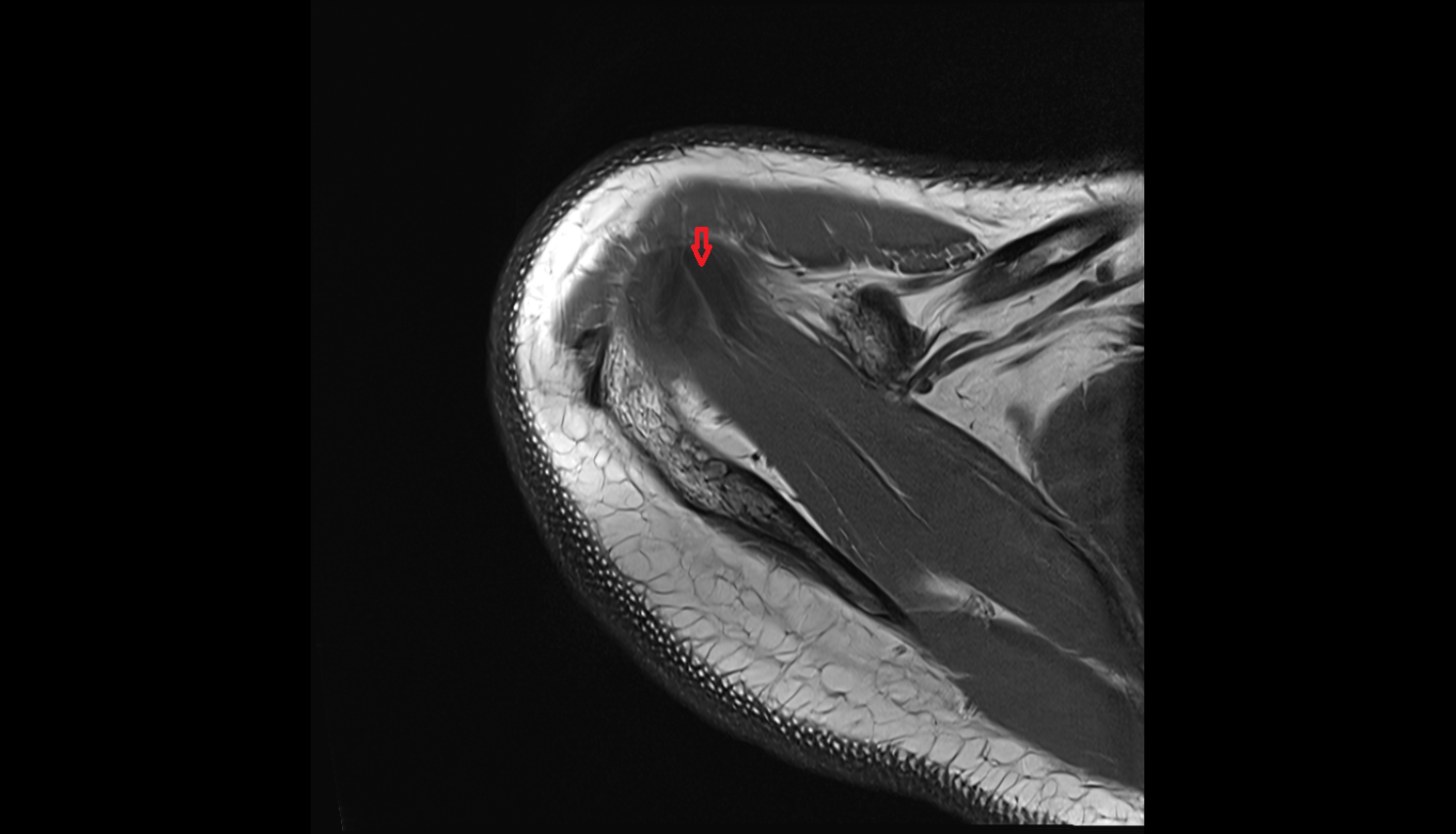 Long head of biceps tendon  axial cross sectional anatomy 3T MRI AI enhanced radiology image-img-00000-00000