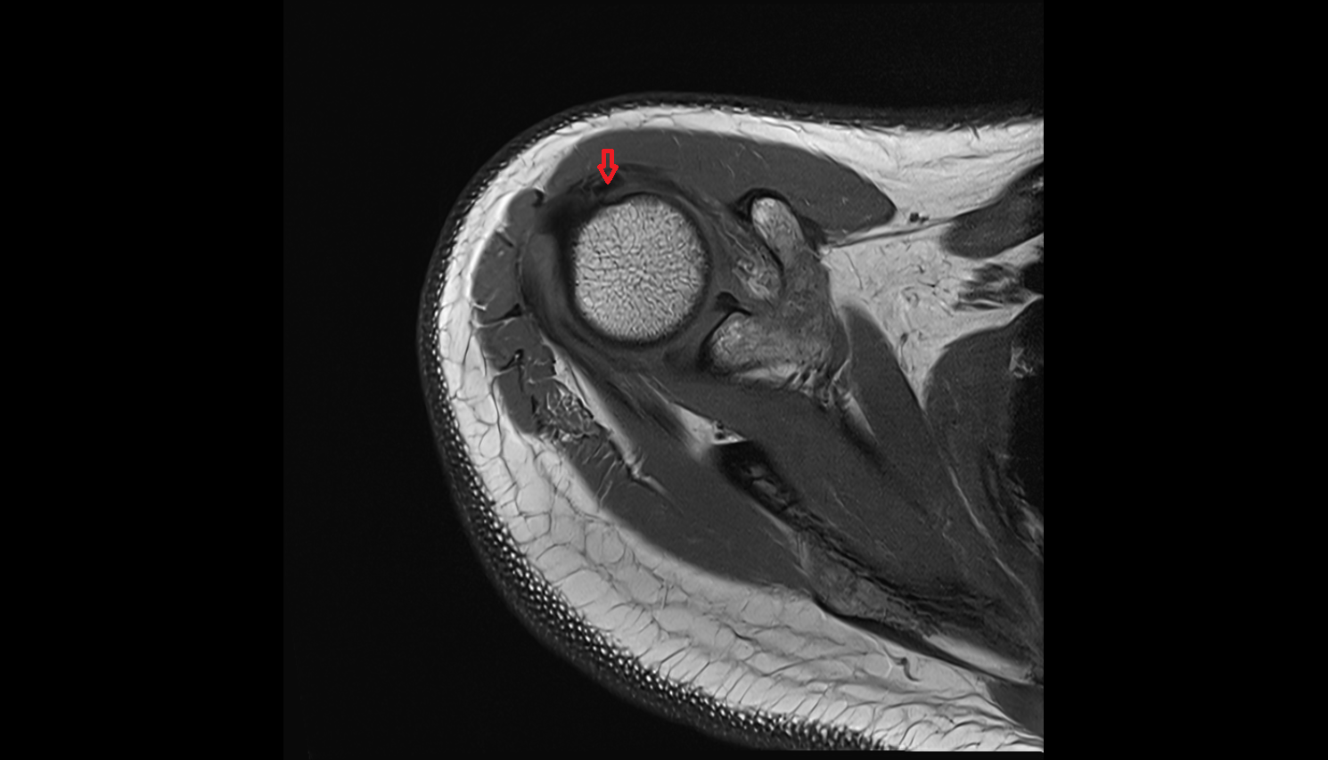 Long head of biceps tendon  axial cross sectional anatomy 3T MRI AI enhanced radiology image-img-00000-00000_00001