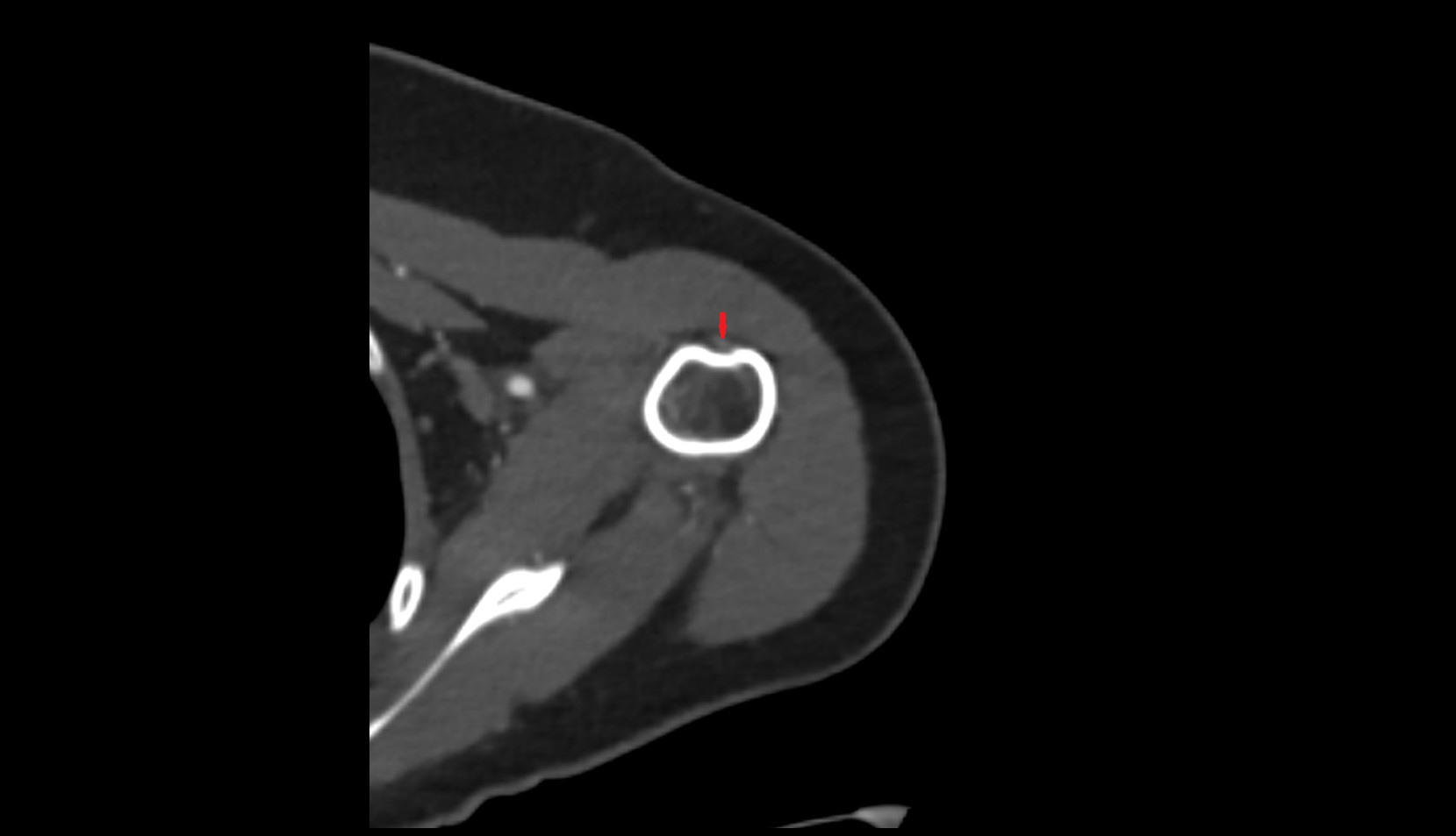 Long head of biceps tendon ct axial