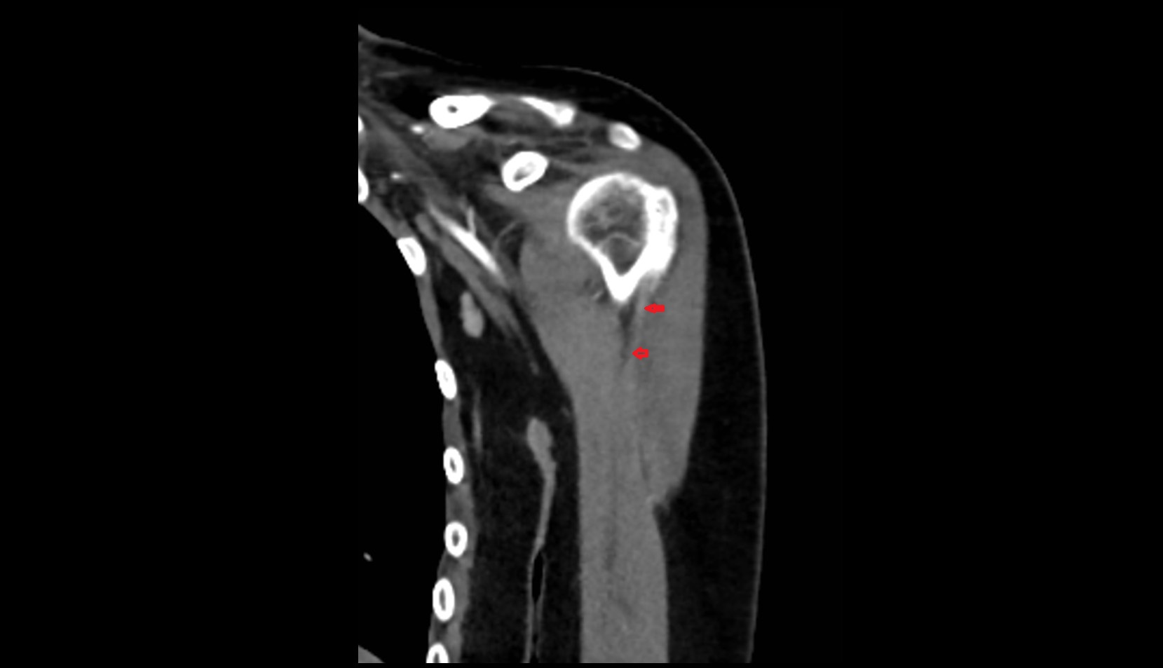 Long head of biceps tendon ct coronal