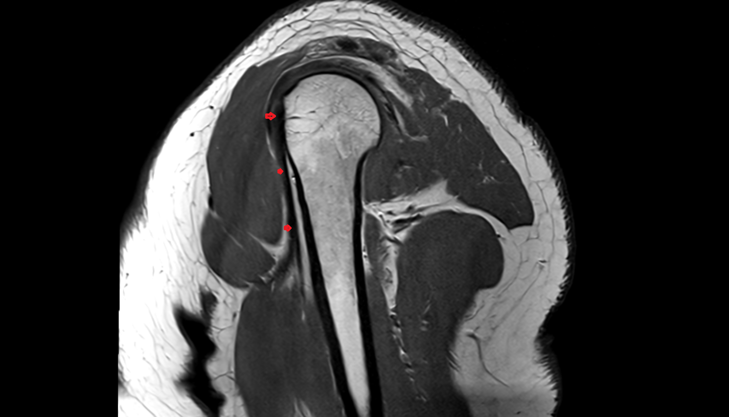 Long head of biceps tendon  sah cross sectional anatomy 3T MRI AI enhanced radiology image-img-00000-00000_00004