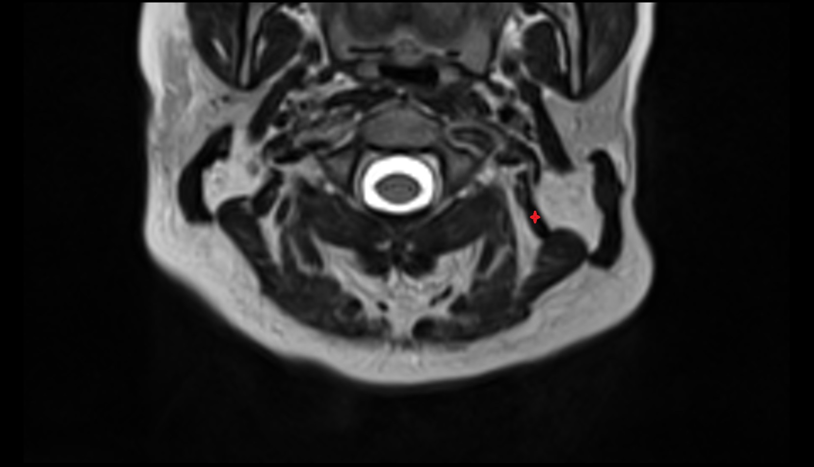 Longissimus capitis muscle MRI AXIAL IMAGE
