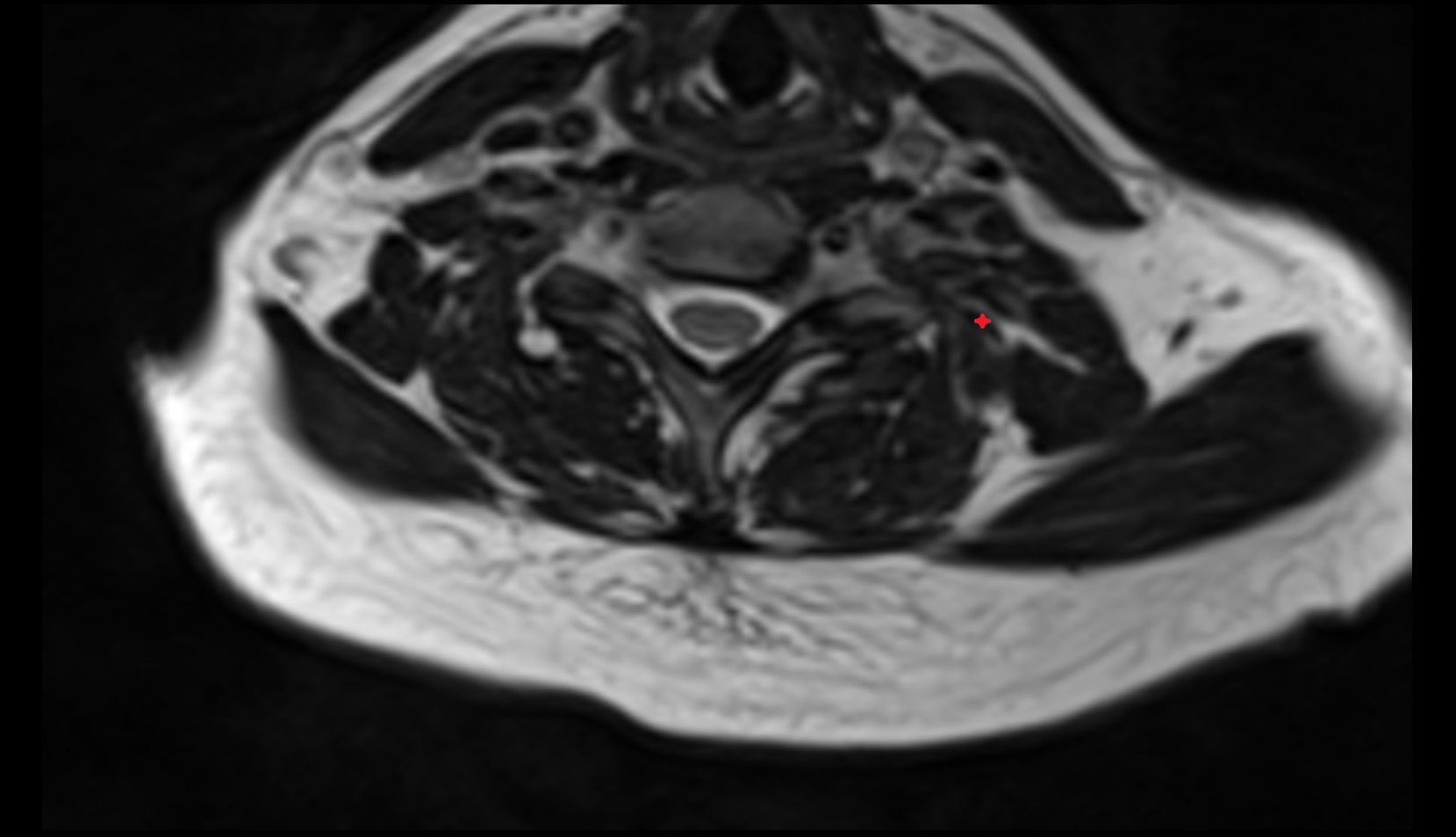 Longissimus cervicis muscle mri axial image